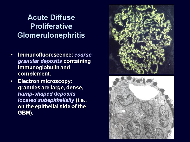 Acute Diffuse Proliferative Glomerulonephritis Immunofluorescence: coarse granular deposits containing immunoglobulin and complement.  Electron